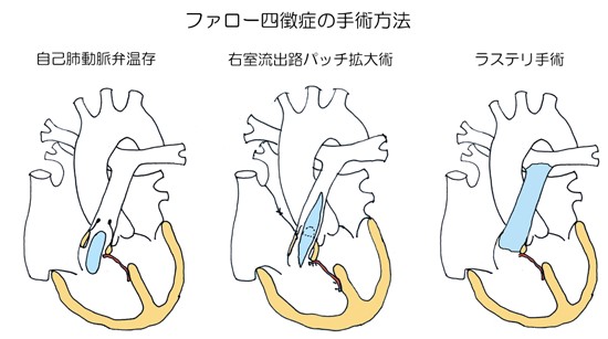 22q11 2欠失症候群 指定難病２０３ 難病情報センター